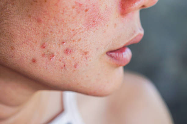 Best skin treatments for acne-prone skin