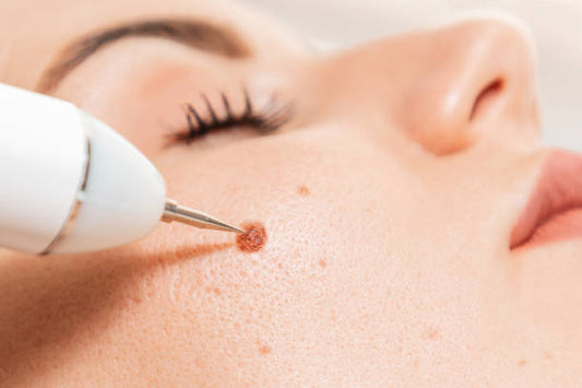 How to Get Rid of Hyperpigmentation: The Best Skin Treatments for Even Skin Tone