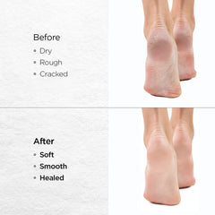 Dr Foot Silicone Gel Heel Socks |Silicone Gel Moisturizer Heel Sleeves To Smooth & Soften Rough Cracked Heels & Dry Feet Or Irritated Heels| For Men & Women | Free Size – 1 Pair