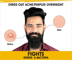 Urbangabru Peel Off Mask and Acne Pimple Patches for Blackheads and Pimple Care (Peel Off Mask 60 Gram + Acne Pimple Patch (72 Dots)