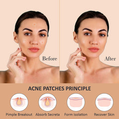 Rejusure Acne Patch | Waterproof Patches | Absorbs Pimple Overnight | Acne Korean Spot Patch for Covering Zits and Blemishes | For All Skin Types | Men & Women - (72 Count) (Pack of 3)